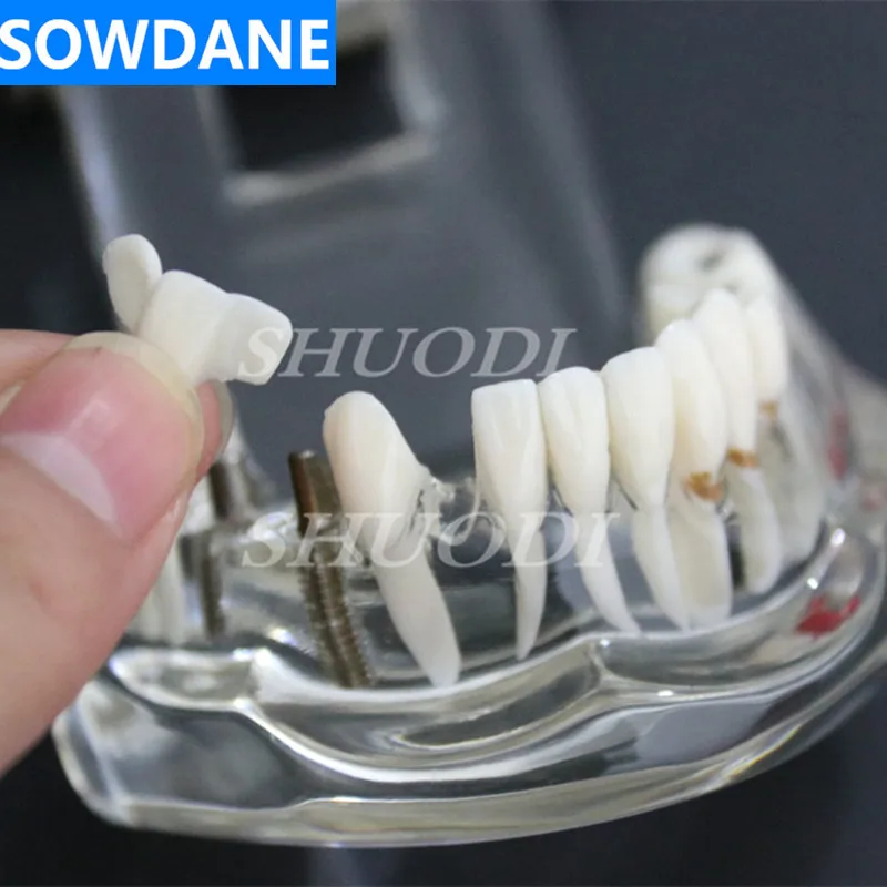 Tandsygdomme Tænder Model Med Restaurering Bro Tand Tandlæge For Medicinsk Videnskab Tandsygdomme Undervisning Undersøgelse