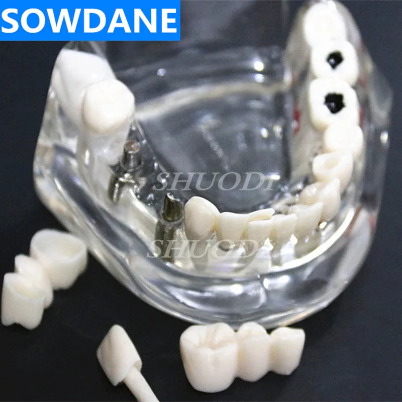 Tandsygdomme Tænder Model Med Restaurering Bro Tand Tandlæge For Medicinsk Videnskab Tandsygdomme Undervisning Undersøgelse